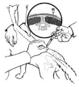 IMMITICIDE ® Sterile Powder